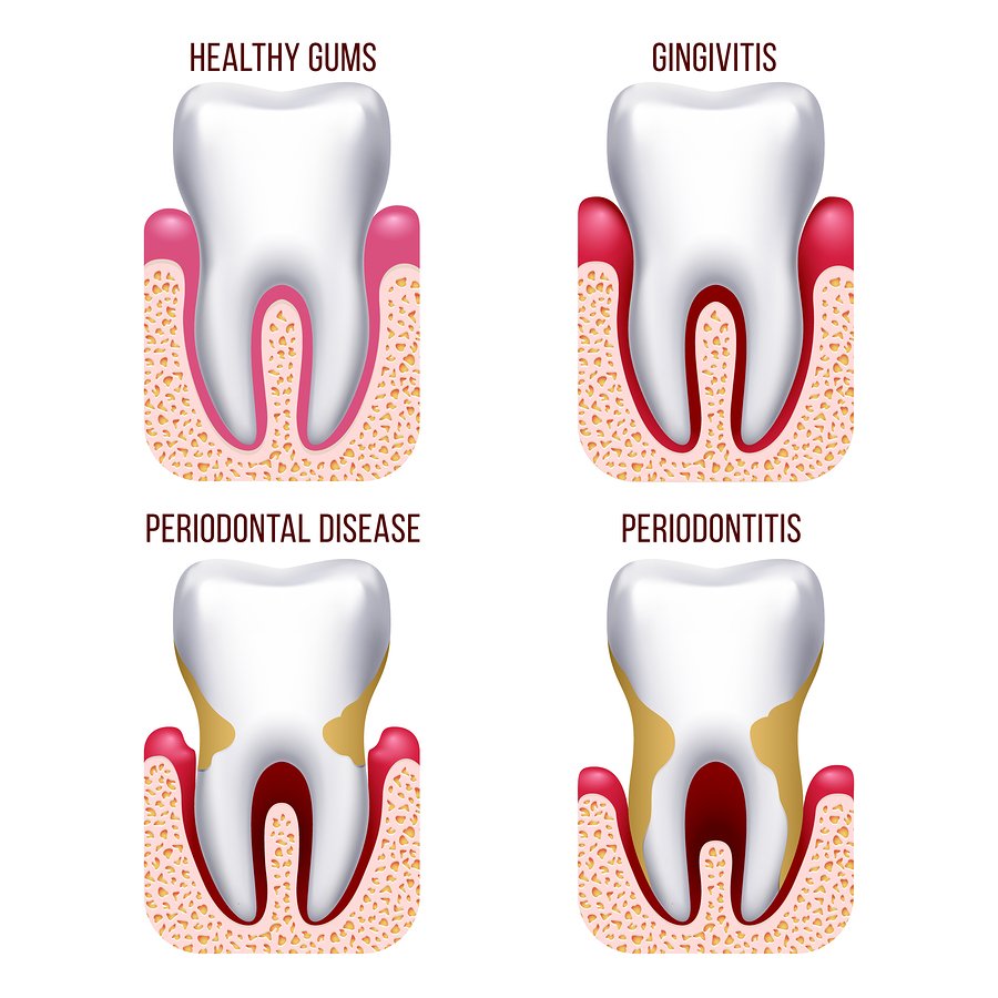 Gum Disease Causes Prevention And Care Gentle Dental