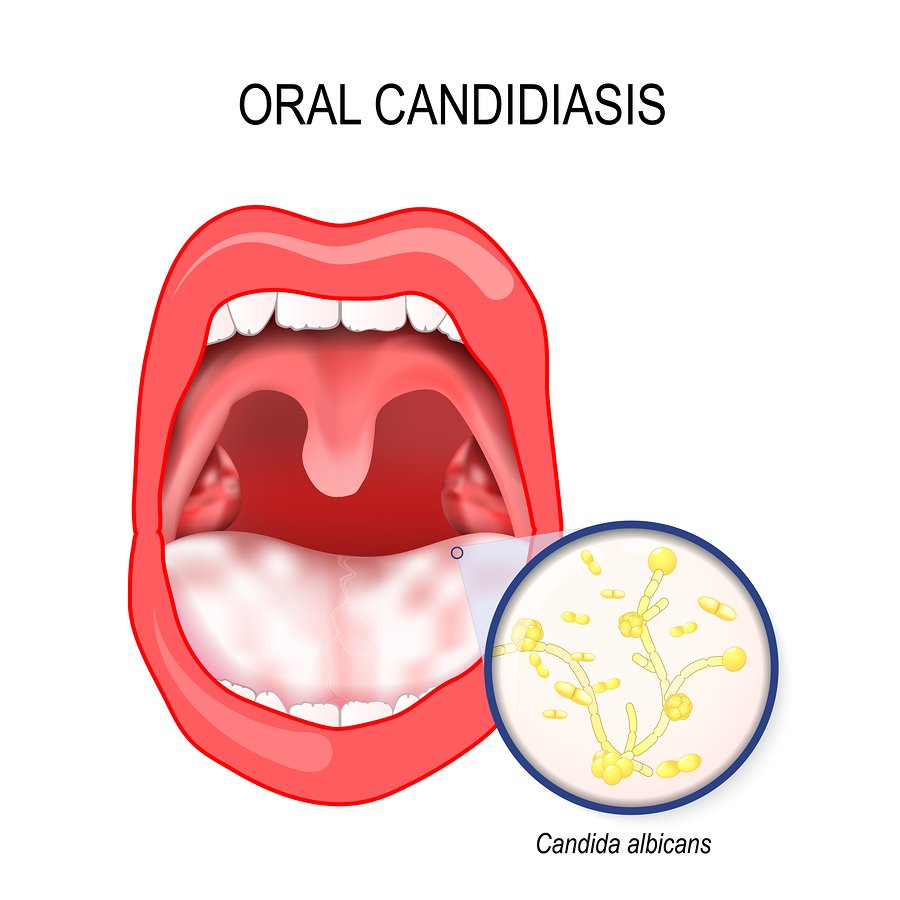 what causes oral thrush in adults