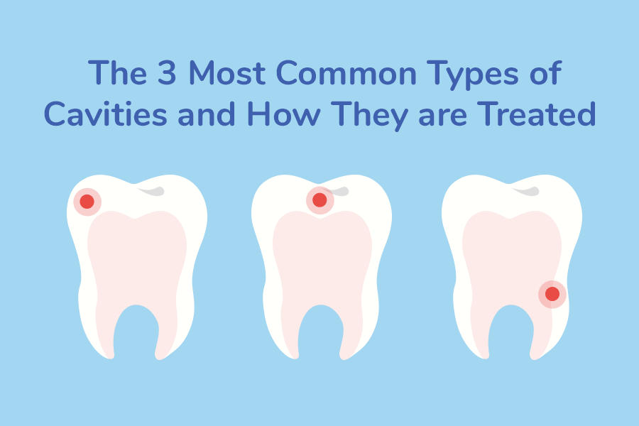3 Types of Cavities & How to Prevent Them